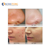 Oxygen injector facial machine Dermabrasion Ultrasonic RF o2 aqua peel therapy Skin deep clean water penetration restoration