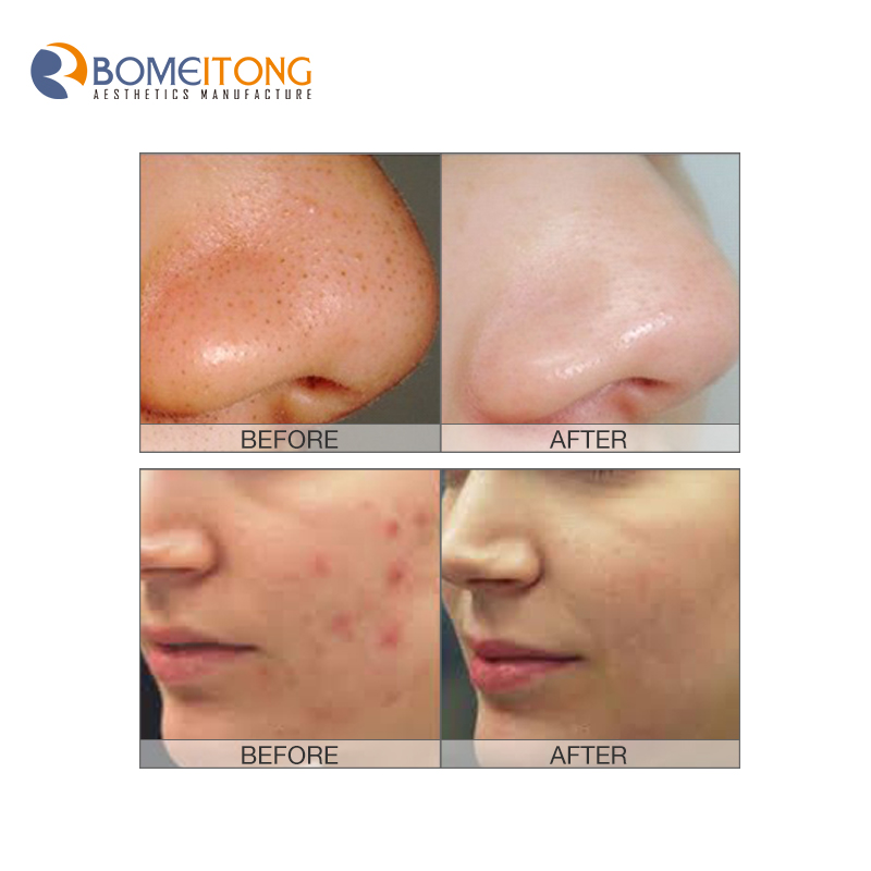 Oxygen jet peel rejuvenation beauty device Ultrasound anti anging deep skin tighten cleansing multifunctional