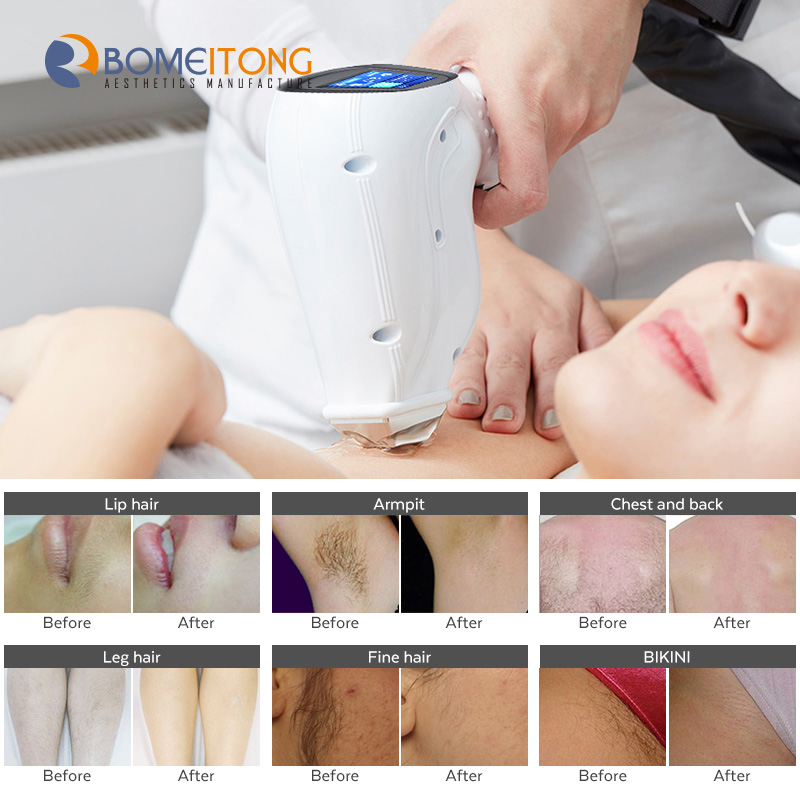 Diode Laser Hair Removal 755 810 1064 permanent therapy for face