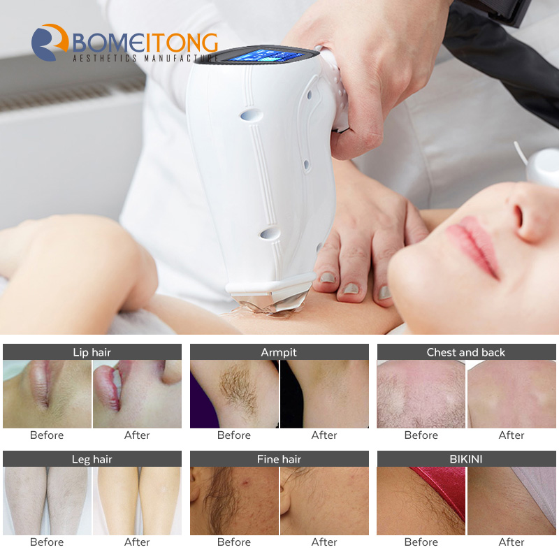 Professional 808nm Diode Hair Removal Equipment Machine 